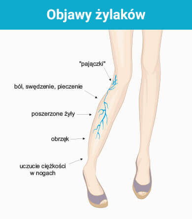 objawy żylaków