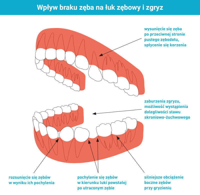 Łukowy i zgryz