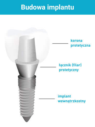 budowa implantu