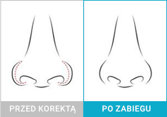 Nos ze zbyt szerokimi nozdrzami