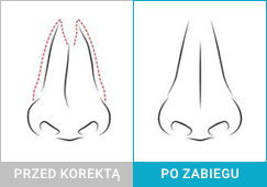 Krzywa przegroda nosowa