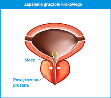 chora prostata